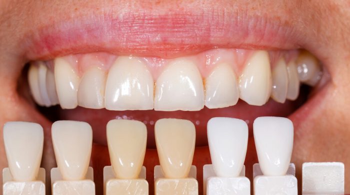 دندان پزشکی عاج | انجام کامپوزیت با ضمانت