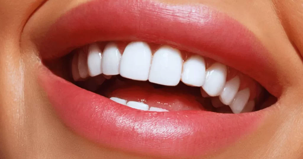 دندان پزشکی عاج | لمینیت اقساطی
