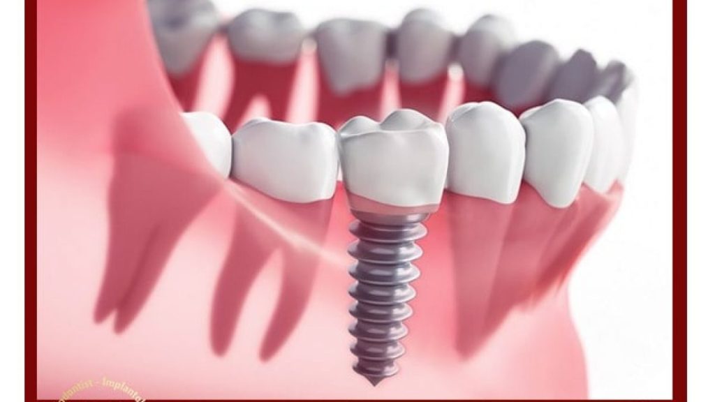 دندان پزشکی عاج | ایمپلنت سویسی اقساطی